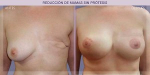 Before and after image of a post-cancer breast reconstruction procedure.